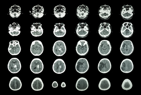 出血性脳卒中と虚血性脳卒中。グレイ解剖学アトラス。 脳の Ct スキャン: 脳出血 (脳